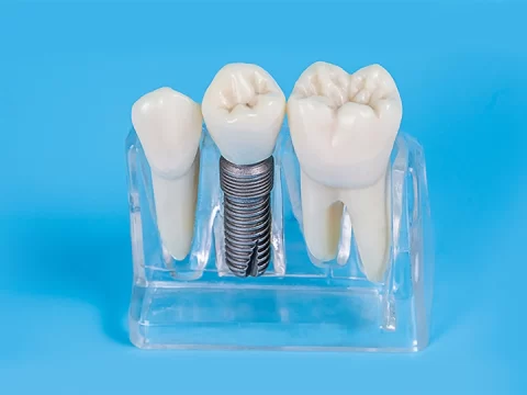 A Few Day-to-Day Benefits of Dental Implants