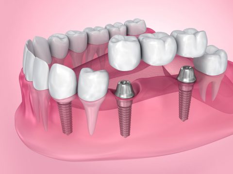Dental Bridges 101: Everything You Need to Know