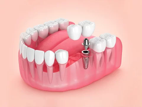 Dental Bridges 101: Everything You Need to Know