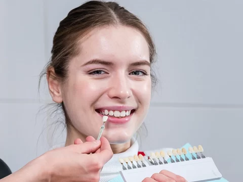 How Many Dental Veneers Do You Need?